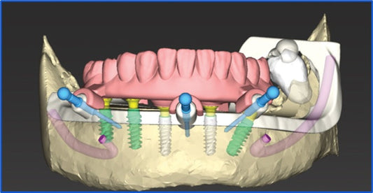 Revolutionizing Digital Dentistry with Full Arch Workflow and AOX Integration