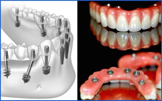 Future of Accurate Full Arch Dentistry by Photogrammetry and Digital Verification Jigs