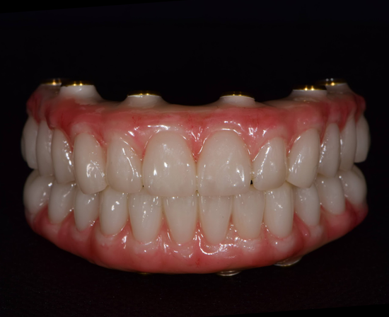 Opti Splint OPTISPLINT Intraoral Full Arch Scanning for All-on-X – Digital Arches LLC